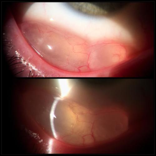 Cyst of the conjunctiva